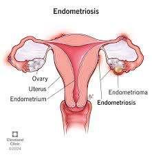 How to Recognize and Manage Endometriosis