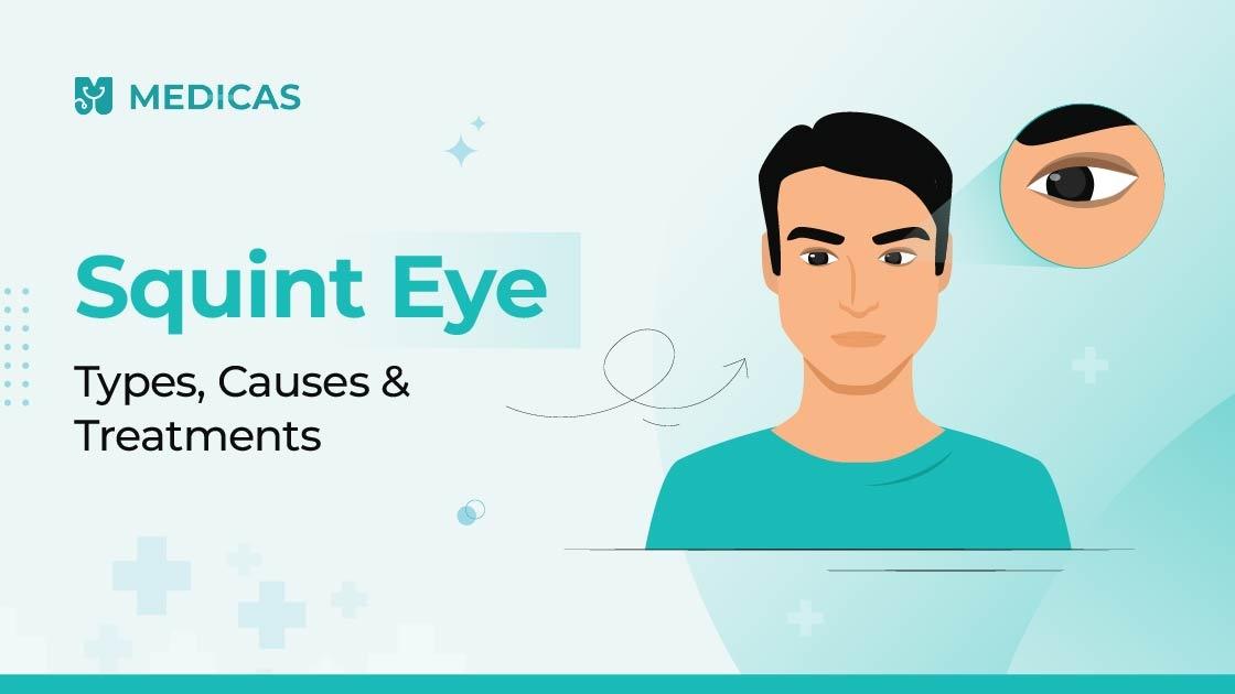 A Complete Guide to Squint Eye: From Diagnosis to Surgery