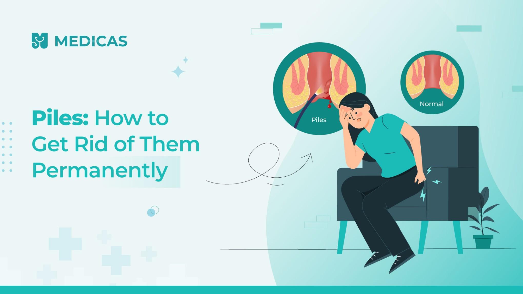 Top Treatments to Cure Piles for Good