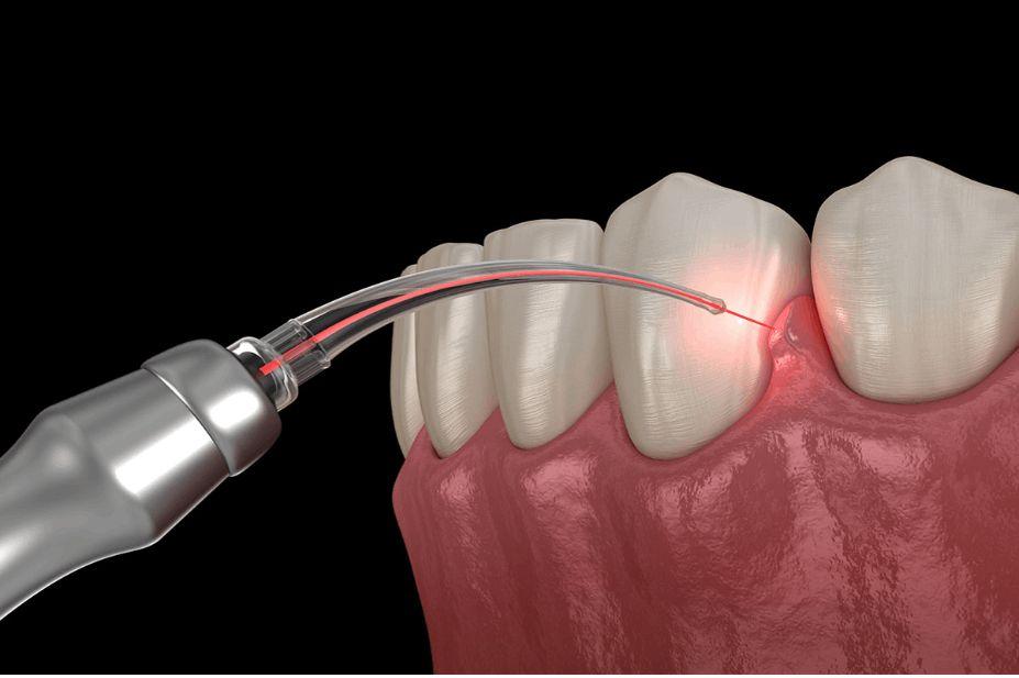 Laser Dentistry in BTM Layout, Bangalore - Perfect Dental Studio