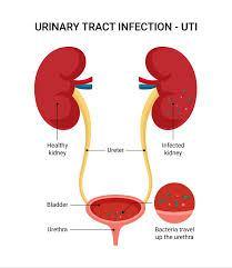 Urology Made Simple: Kidney Stones, UTIs, and More Explained