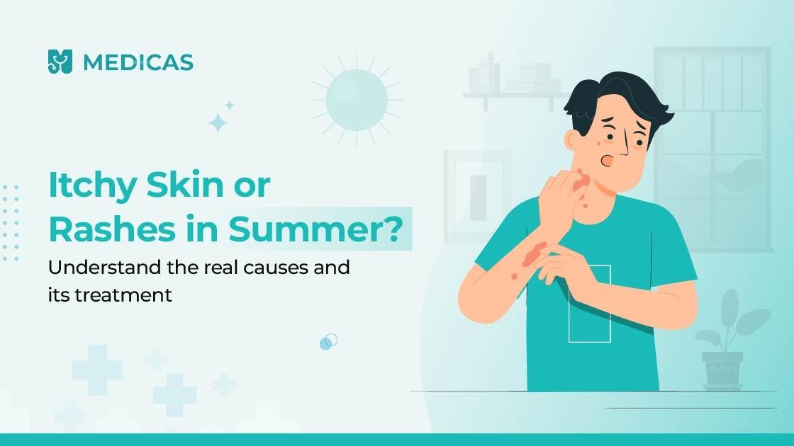 From Heat Rash to Sun Allergy: Your Summer Skin Survival Guide