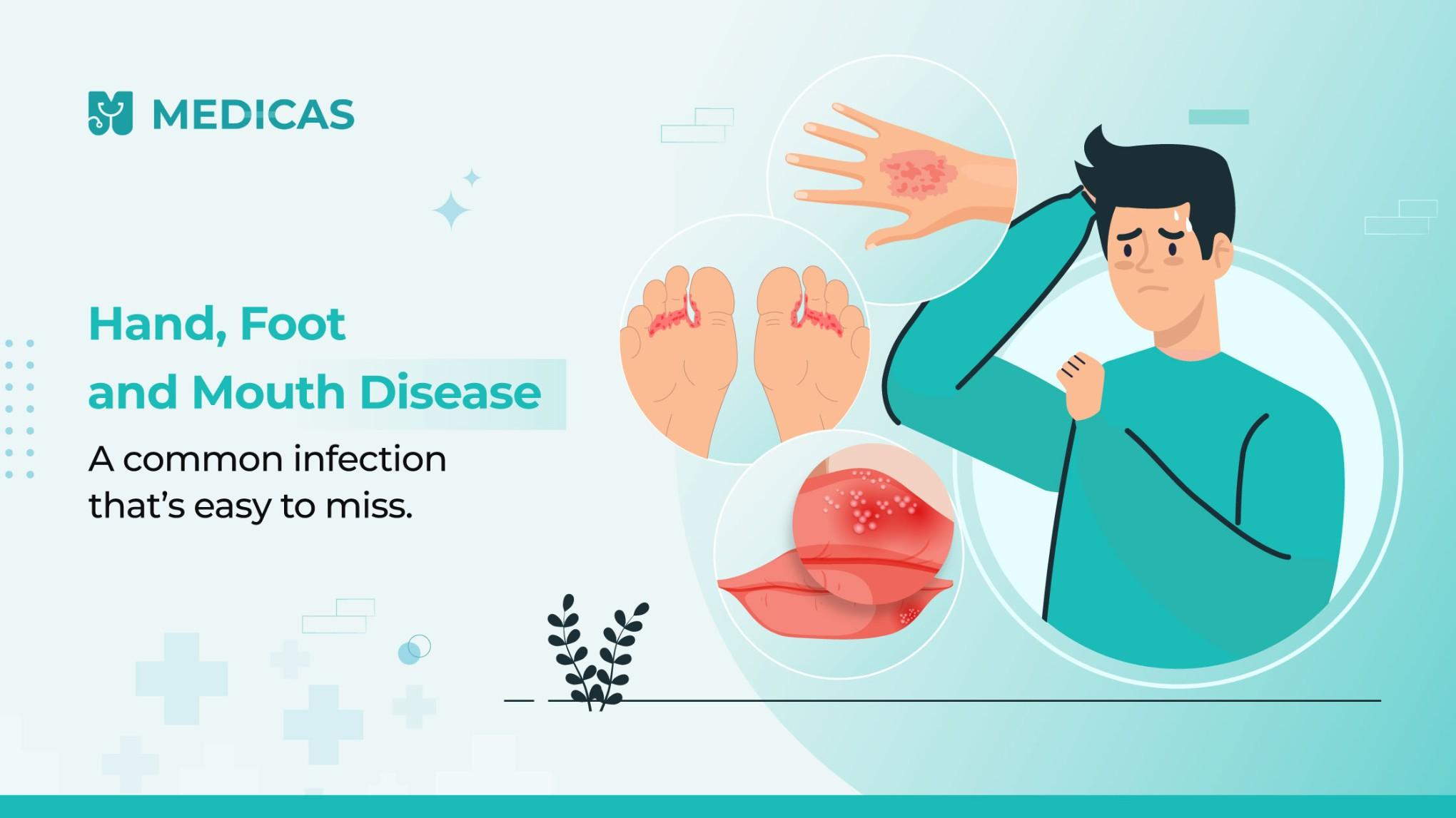 Is It Time to Call the Doctor for Hand, Foot and Mouth Disease?