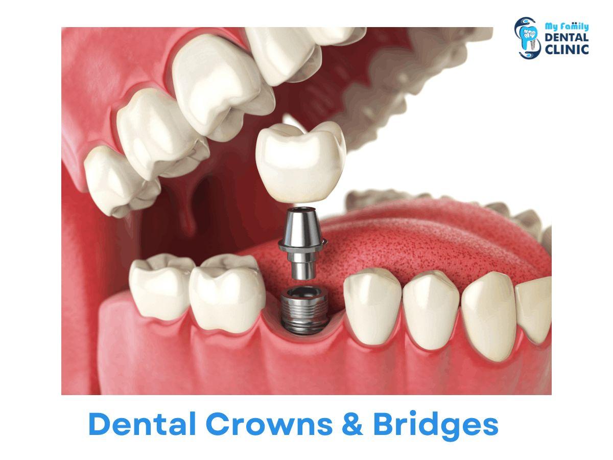 Dental Crowns & Bridges-dental clinic in karve nagar