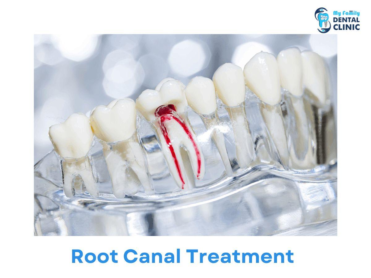 Root Canal Treatment-My Family Dental Clinic 