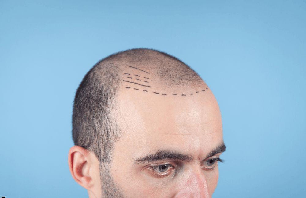Top Hair Transplant in Delhi | Trusted Clinic for Natural Results