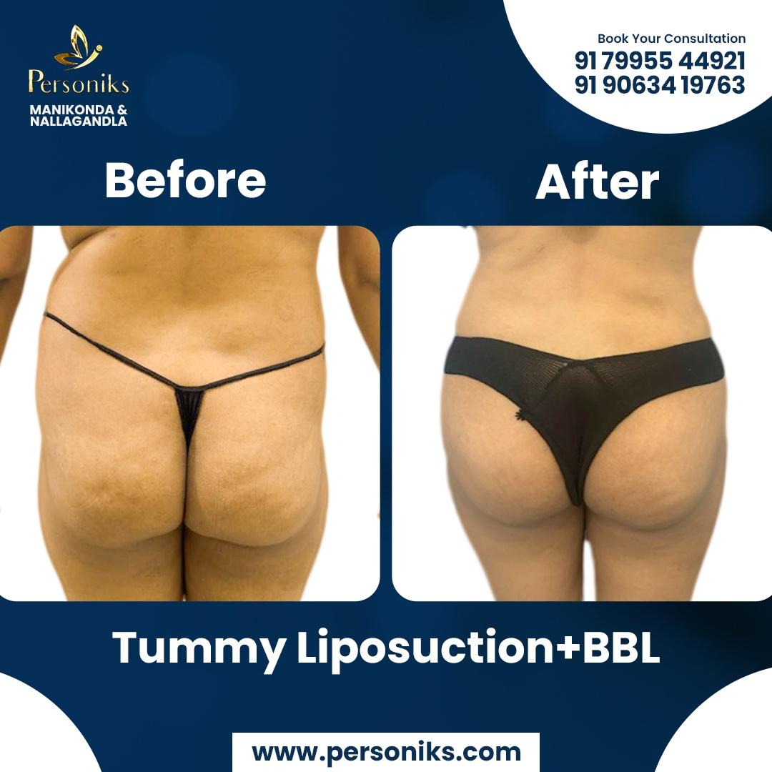  Tummy Liposuction + BBL Transformation Results 