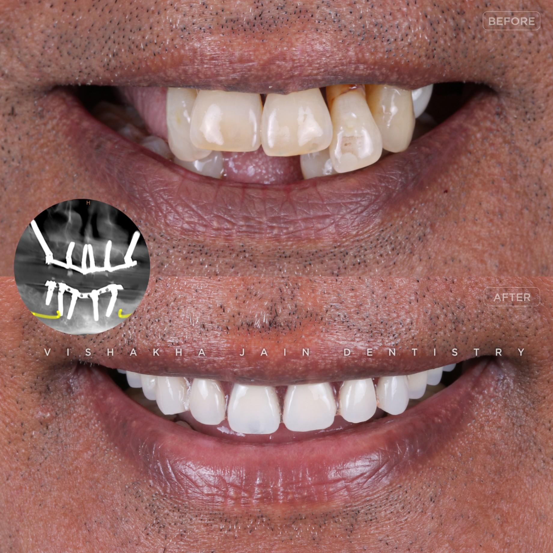 Dental Implant Treatment in Indore