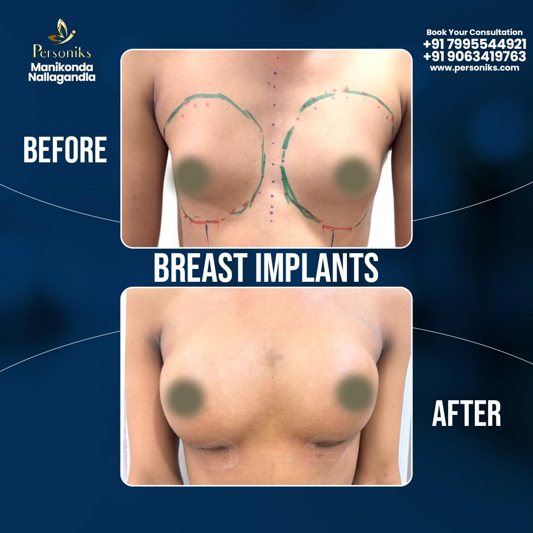 Restoring Confidence Through Advanced Breast Implant Procedures