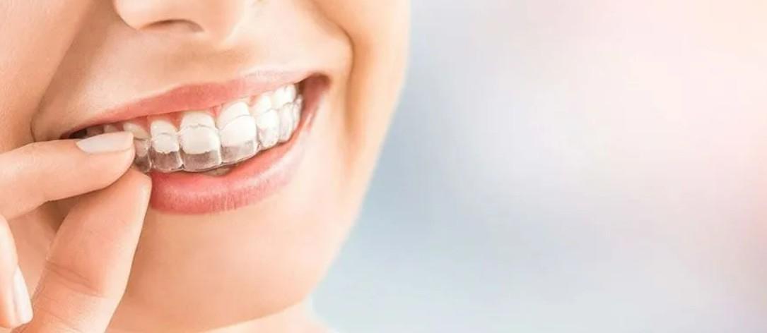 Transform Your Smile with Invisible Braces in Gurgaon