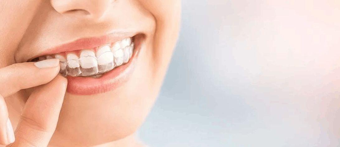 A Clear Guide to Invisible Braces Cost in Gurgaon
