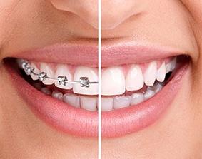 Best dental aligners in hanamkonda\