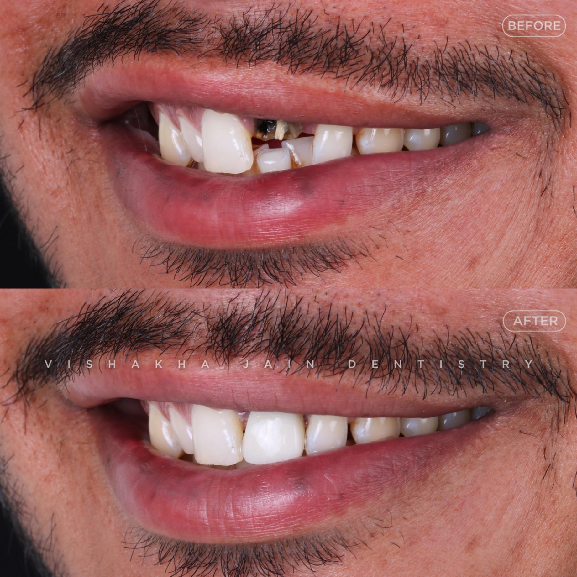 Dentist in Indore Advanced & Affordable Dental Care for a Healthy Smile