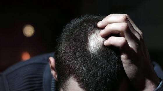 Alopecia Areata Treatment in Matunga