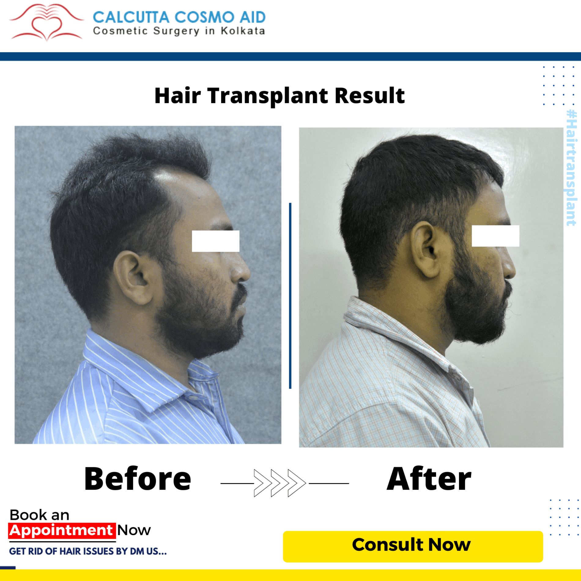 Calcutta Cosmo Aid - Best hair transplant in Kolkata, Gynecomastia & Breast Surgery Clinic in Kolkata