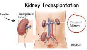 Kidney Transplant Cost in India 