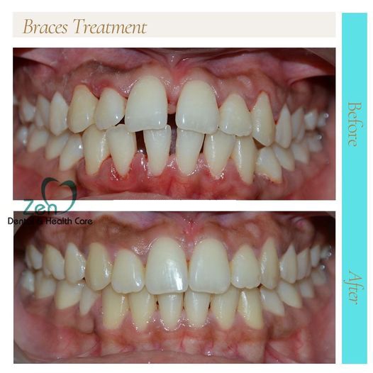Transform Your Smile with Dental Braces Treatment in Bangalore