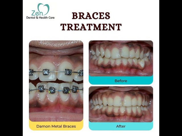 Best Dental Braces Treatment in Bangalore 